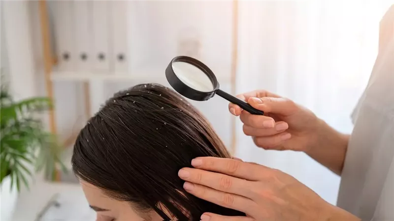 4 علاجات منزلية لقشرة الشعر.. تجنب هذه الوصفات