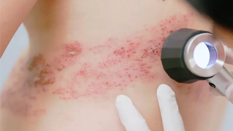 فئات معرضة للحزام الناري.. هل للتوتر دور في ذلك؟