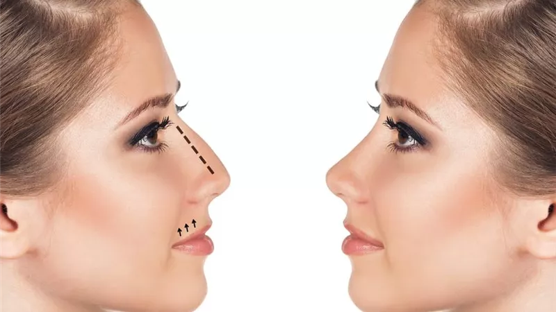 هل يمكن رفع طرف الأنف بدون جراحة تجميل؟ 