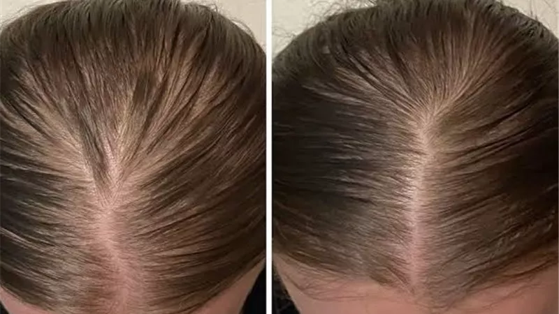  Oral Minoxidil صيحة جديدة في عالم العناية بالشعر
