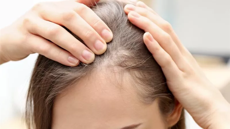انتبه.. مشروبك المفضل قد يسبب تساقط شعرك؟